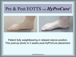 Pre & Post EOTTS withHyProCure®Patient fully weightbearing in relaxed stance position.  This post-op photo is 3 weeks post-HyProCure placement.www.HyProCure.com