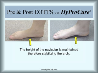 Pre & Post EOTTS withHyProCure®The height of the navicular is maintained therefore stabilizing the arch.www.HyProCure.com