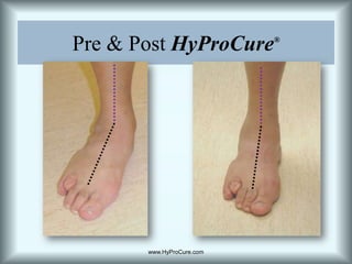 Pre & Post HyProCure®www.HyProCure.com