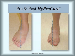 Pre & Post HyProCure®www.HyProCure.com