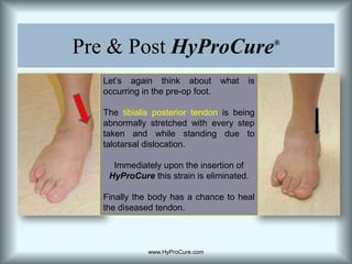 Pre & Post HyProCure®Let’s again think about what is occurring in the pre-op foot.  The tibialis posterior tendon is being abnormally stretched with every step taken and while standing due to talotarsal dislocation.Immediately upon the insertion of HyProCure this strain is eliminated.Finally the body has a chance to heal the diseased tendon. www.HyProCure.com