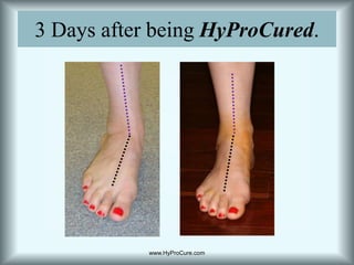 3 Days after being HyProCured.www.HyProCure.com