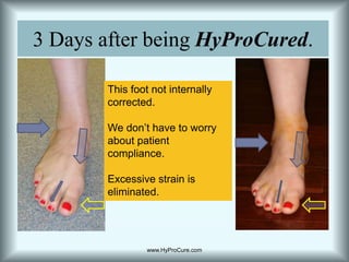 3 Days after being HyProCured.This foot not internally corrected.We don’t have to worry about patient compliance.Excessive strain is eliminated.www.HyProCure.com