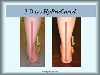 3 Days HyProCured.www.HyProCure.com