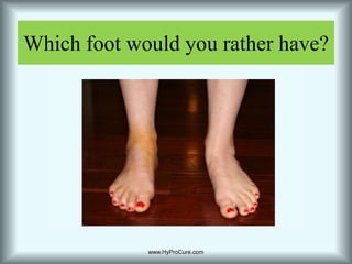 Which foot would you rather have?www.HyProCure.com