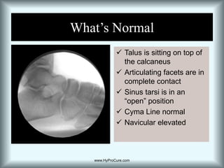 What’s NormalTalus is sitting on top of the calcaneus