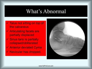 Articulating facets are in complete contact