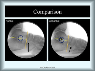 Sinus tarsi is in an “open” position