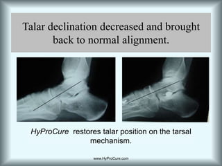 Navicular elevatedwww.HyProCure.com