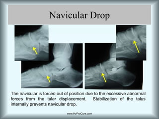 What’s AbnormalTalus not sitting on top of the calcaneus