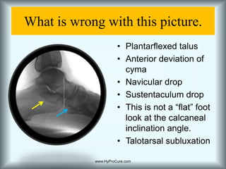 Articulating facets are partially displaced