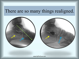 Sinus tarsi is partially collapsed/obliterated
