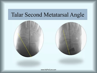 ComparisonNormalAbnormalwww.HyProCure.com