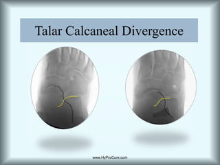 Repositioning of the talus on the tarsal mechanism.HyProCure stabilizes the talus to prevent anterior dislocation. Maintains the articular facets, keeps the sinus open.www.HyProCure.com