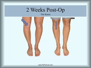 Navicular DropThe navicular is forced out of position due to the excessive abnormal forces from the talar displacement.  Stabilization of the talus internally prevents navicular drop. www.HyProCure.com