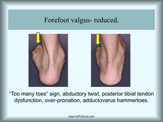 Forefoot valgus- reduced.“Too many toes” sign, abductory twist, posterior tibial tendon dysfunction, over-pronation, adductovarus hammertoes.www.HyProCure.com