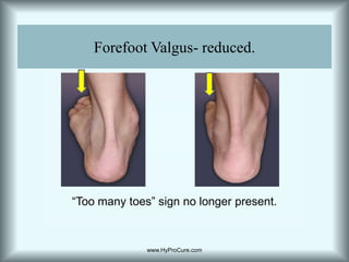 Forefoot Valgus- reduced.“Too many toes” sign no longer present.www.HyProCure.com