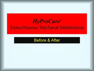 HyProCure®Extra-Osseous TaloTarsal Stabilization Before & After 