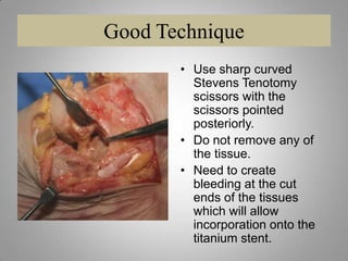 There is no such thing as a complication-free surgical procedure.Something can always potentially go wrong.