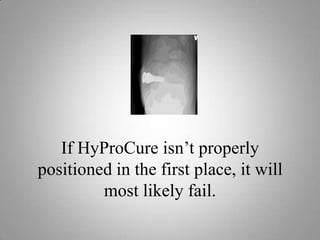 Potential ComplicationsDisplacement of the stent