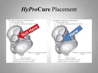 “Sprained Ankle Syndrome” 