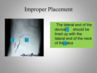 Abnormal walking pattern
