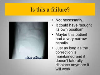 Need for stent removal