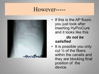 Other risks associated with surgeryHyProCure DisplacementPartial to Full 