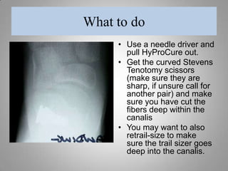 HyProCure DisplacementMost likely due toPoor placement initiallyFailure to cut the interosseous ligamentPoor patient compliance Too active – too soonTrauma – severe ankle sprain/twistWrong implant size (too small/too large)Bilateral case  Displacement rarely occurs after 3 to 4 weeks  (<2% chance)