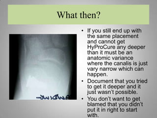 RememberWe are at the mercy of the soft tissues within the sinus tarsi to anchor the stent and hold it in place. You need to cut these tissues in order to create a tissue enveloped to insert HyProCure.