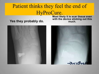 Need to create bleeding at the cut ends of the tissues which will allow incorporation onto the titanium stent.Did you place HyProCure where it is supposed to go?The medial tip should be within the canalis portion of the sinus tarsi not  	abutting the lateral neck of the talus.