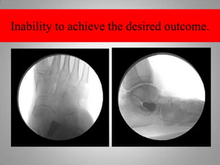 Improper Placement     The lateral end of the device       should be lined up with the lateral end of the neck of the talus 1122