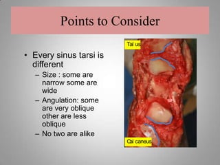 Takes a good 3 to 4 weeks for the tissues to adhere to the stent to lock into its final position.Points to Consider