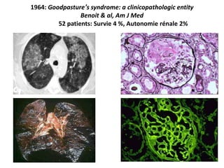 1964: Goodpasture’s syndrome: a clinicopathologic entity
Benoit & al, Am J Med
52 patients: Survie 4 %, Autonomie rénale 2%
 