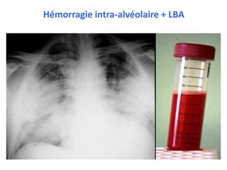 Hémorragie intra-alvéolaire + LBA
 