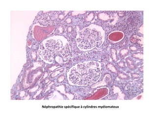 Néphropathie spécifique à cylindres myélomateux
 