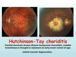 Hutchinson-Tay choriditis
Familial dominant drusen (Doyne honeycomb choroiditis, malattia 
leventinese) is thought to represent an early-onset variant of age-
related macular degeneration.
 