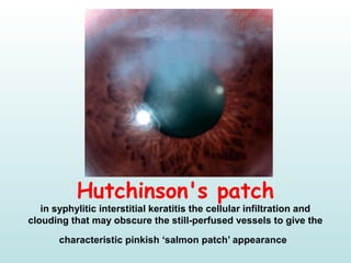 Hutchinson's patch
in syphylitic interstitial keratitis the cellular infiltration and 
clouding that may obscure the still-perfused vessels to give the 
characteristic pinkish ‘salmon patch’ appearance
 