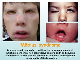Möbius syndrome
is a rare, usually sporadic, condition, the basic components of
which are congenital non-progressive bilateral sixth and seventh
cranial nerve palsies that are believed to relate to a developmental
abnormality of the brainstem 
 