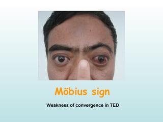 Möbius sign
Weakness of convergence in TED
 