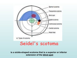 Seidel's scotoma
 is a sickle-shaped scotoma that is a superior or inferior
extension of the blind spot
 