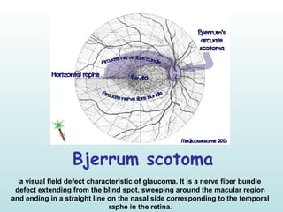Bjerrum scotoma
a visual field defect characteristic of glaucoma. It is a nerve fiber bundle
defect extending from the blind spot, sweeping around the macular region
and ending in a straight line on the nasal side corresponding to the temporal
raphe in the retina.
 