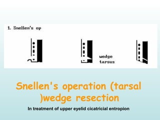 Snellen's operation (tarsal
wedge resection)
In treatment of upper eyelid cicatricial entropion
 