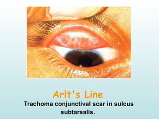 Arlt's Line 
Trachoma conjunctival scar in sulcus
subtarsalis. 
 