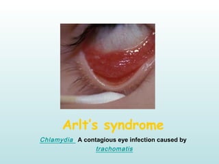 Arlt’s syndrome
A contagious eye infection caused by Chlamydia
trachomatis
 