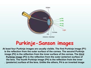 Purkinje-Sanson images
At least four Purkinje images are usually visible. The first Purkinje image (P1)
is the reflection from the outer surface of the cornea. The second Purkinje
image (P2) is the reflection from the inner surface of the cornea. The third
Purkinje image (P3) is the reflection from the outer (anterior) surface of
the lens. The fourth Purkinje image (P4) is the reflection from the inner
(posterior) surface of the lens. Unlike the others, P4 is an inverted image.
 