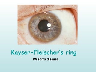 Kayser-Fleischer’s ring
Wilson’s disease
 