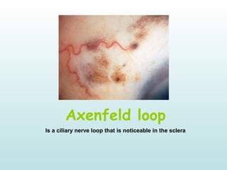 Axenfeld loop
Is a ciliary nerve loop that is noticeable in the sclera
 