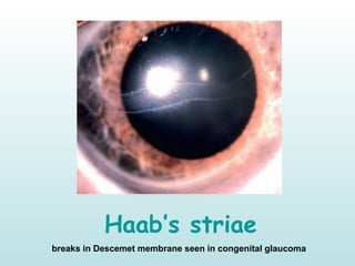 Haab’s striae
breaks in Descemet membrane seen in congenital glaucoma
 