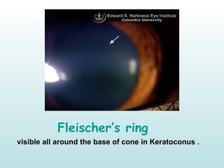 Fleischer’s ring
visible all around the base of cone in Keratoconus .
 